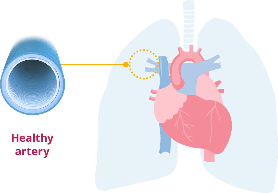 Heart with healthy, open artery