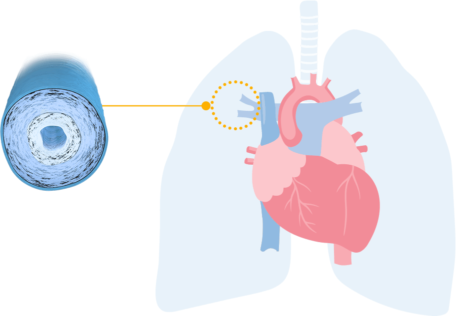 Heart with PAH artery that is becoming stiff and narrow