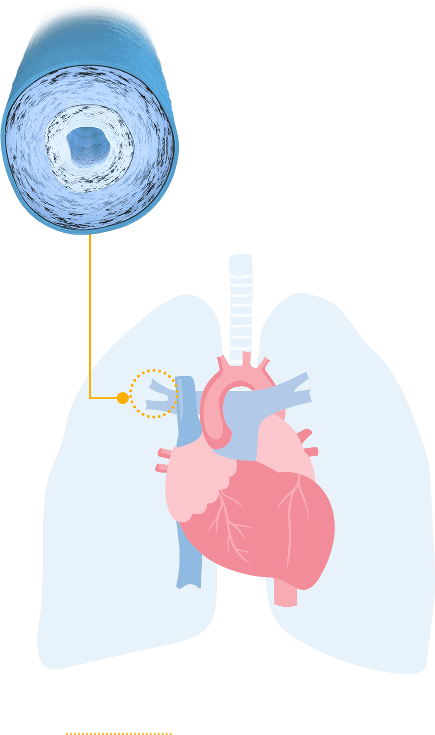 Heart with PAH artery that is becoming stiff and narrow