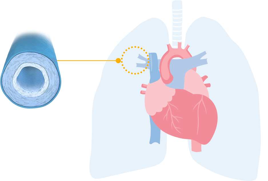 Lungs with healthy arteries