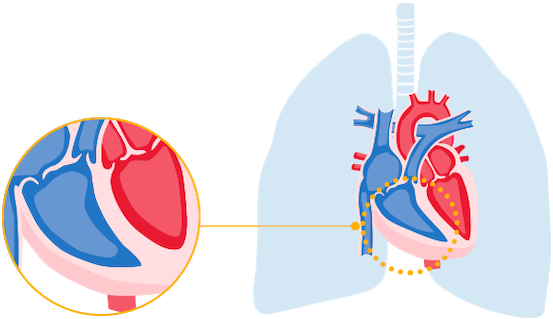 Heart with thick walls