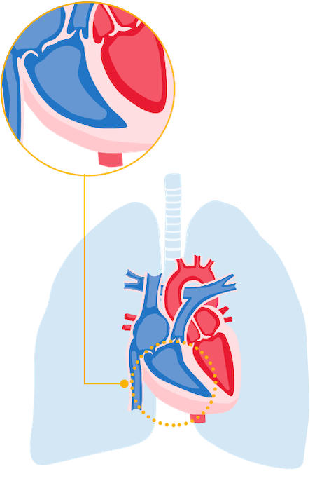 Right side of heart with thick walls