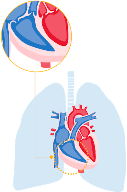 Long view of heart with thick walls