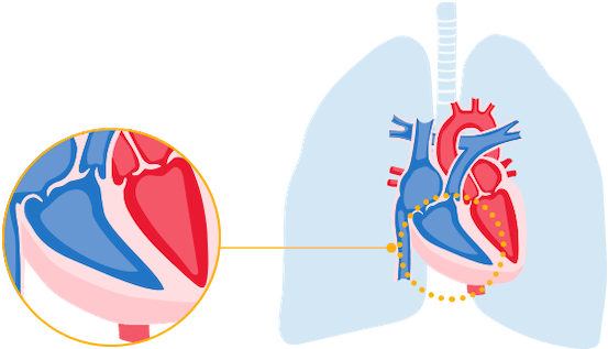 Heart with thick walls