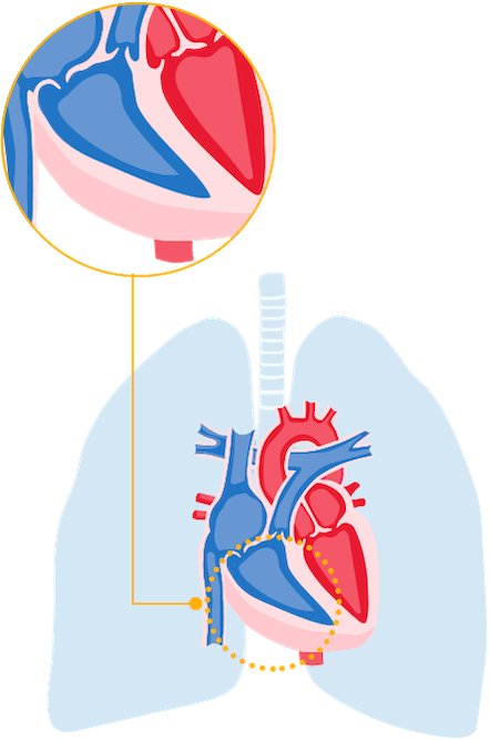 Long view of heart with thick walls